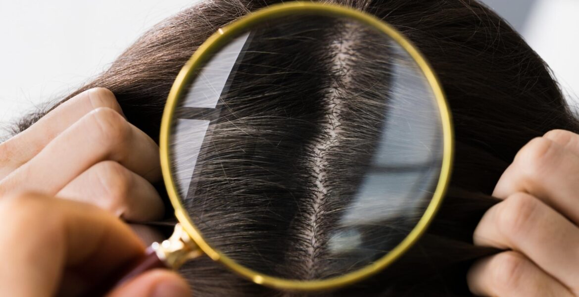 Τριχόπτωση Θεραπεία για Γυναίκες