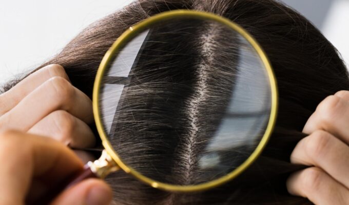 Τριχόπτωση Θεραπεία για Γυναίκες