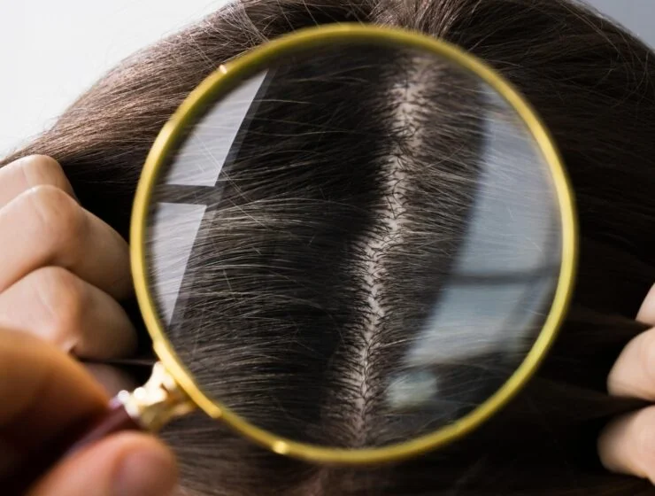 Τριχόπτωση Θεραπεία για Γυναίκες